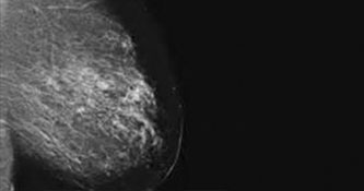 mammo-medical-imaging